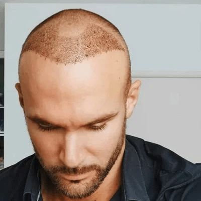 Turkish Hair Transplant in Islamabad Pakistan