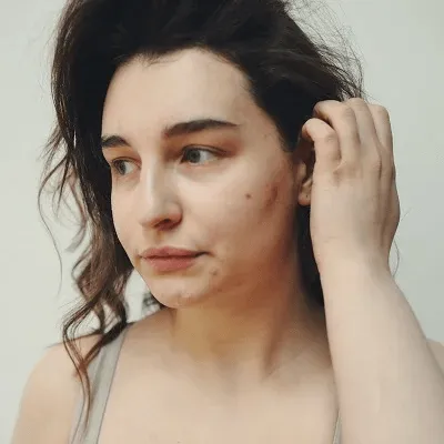 does glutathione cause purging Why Does Glutathione Cause Acne Breakouts
