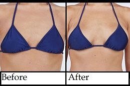 Best Breast Augmentation in Islamabad