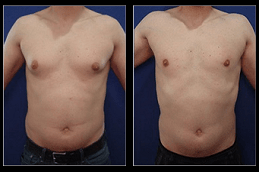 Best Gynecomastia in Islamabad