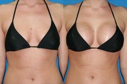 Breast Augmentation Cost in Islamabad