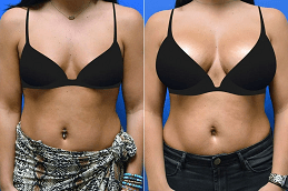 Breast Augmentation in Islamabad Glamorous Clinic Islamabad