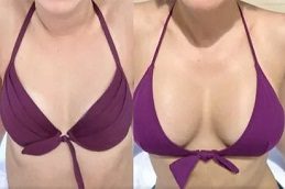 Breast Augmentation in Islamabad Glamorous Clinic