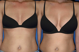 Breast Augmentation in Islamabad Pakistan