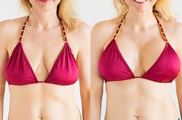 Breast Augmentation in Islamabad