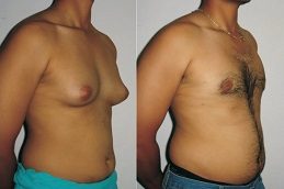 Gynecomastia Cost in Islamabad