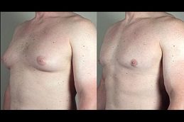 Gynecomastia Treatment in Islamabad
