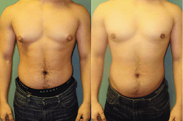 Gynecomastia in Islamabad
