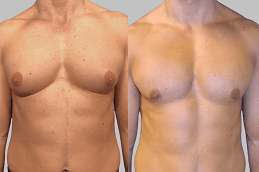 Gynecomastia in Islamabad Cheapest Price