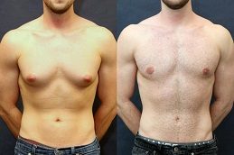 Gynecomastia in Islamabad Glamorous Clinic