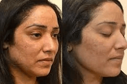 Best Melsama Treatment Clinic in Islamabad