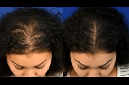 Best prp hair treatment Clinic in Islamabad