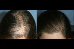 Best prp hair treatment in Rawalpindi