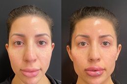 Dermal Fillers Injections Cost in Islamabad