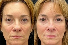 Dermal Fillers Injections in Islamabad Cheapest Price