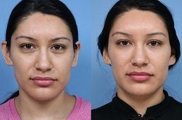 Dermal Fillers Injections in Islamabad Cost & Price
