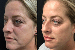 Dermal Fillers Injections in Pakistan