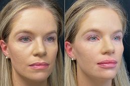 Dermal Fillers Injections