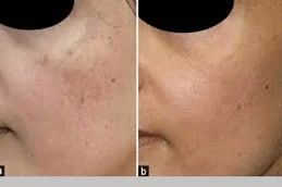 Melsama Treatment in Islamabad Pakistan