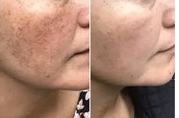 Melsama Treatment in Islamabad