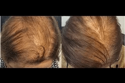 Prp hair treatment Clinic in Islamabad