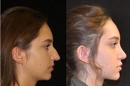 Rhinoplasty-Nose-Reshaping-in-Islamabad-Pakistan