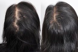 best prp hair treatment in Islamabad