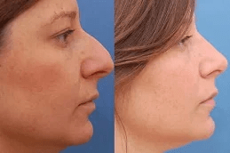 best-rhinoplasty-nose-surgery-in-ISLAMABAD.jpg