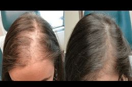 prp hair treatment in Islamabad