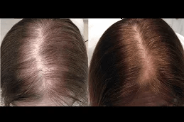 prp hair treatment in rawalpindi