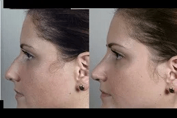 rhinoplasty-nose-surgery-in-ISLAMABAD.jpg
