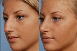 rhinoplasty-nose-surgery-in-rAWALPINDI.jpg