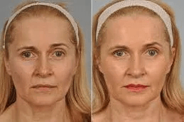 Best Botox Injections in Islamabad