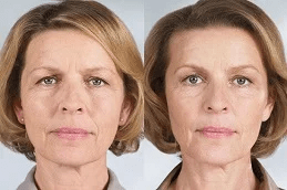 Best Sculptra Fillers in Islamabad Pakistan