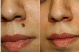 Best moles removal Clinic in Islamabad