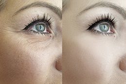 Dark Circles Treatment in Islamabad Pakistan Glamorous Clinic