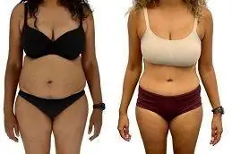 Results OF Best Tummy Tuck Surgeon Clinic in Islamabad