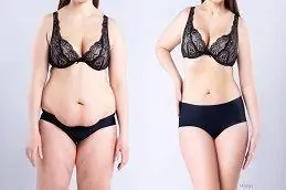 Results OF Best Tummy Tuck Surgeon Islamabad