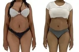 Results OF Best Tummy Tuck Surgeon in Islamabad