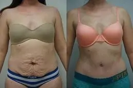 Results OF Best Tummy Tuck Surgeon