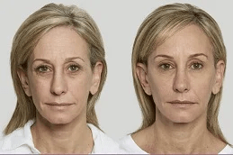 Sculptra Fillers Clinic in Islamabad Pakistan