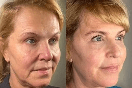 Sculptra Fillers in Islamabad Pakistan Cost