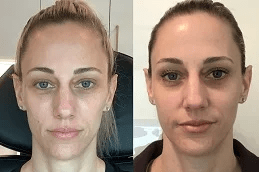 Sculptra Fillers in Islamabad Pakistan Glam Aesthetics