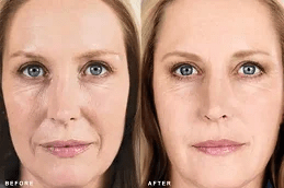 Sculptra Fillers in Islamabad