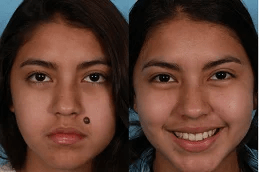 best moles removal in ISLAMABAD