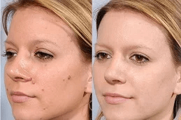 moles removal Clinic in Islamabad