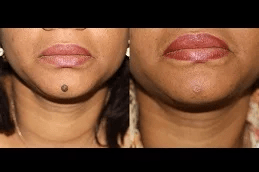 moles removal in ISLAMABAD