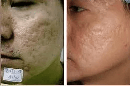 Best Clinic for Laser Fractional Co2 in Islamabad