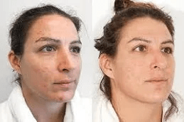 Best Laser Fractional Co2 in Islamabad Pakistan