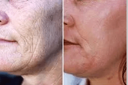 Best Laser Fractional Co2 in Islamabad